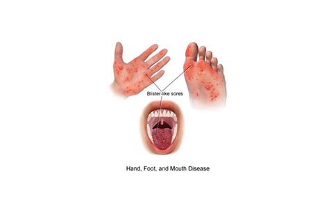 foothunhd|How Hand, Foot, and Mouth Disease Spreads .